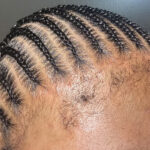 Tight Braids Cause Hair Loss