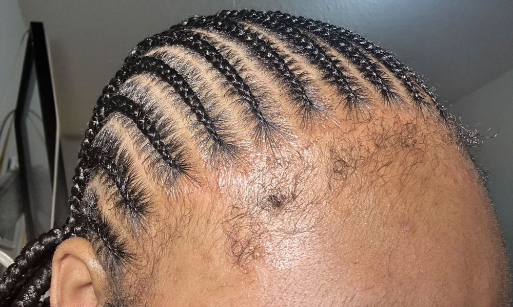 Tight Braids Cause Hair Loss